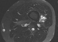 Hemangioma Soft Tissue